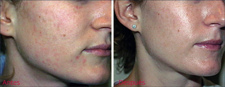 Acne Treatment - Total Dermatology